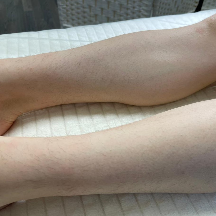 Изображение зоны ног до процедуры шугаринга, показана кожа с растущими волосками