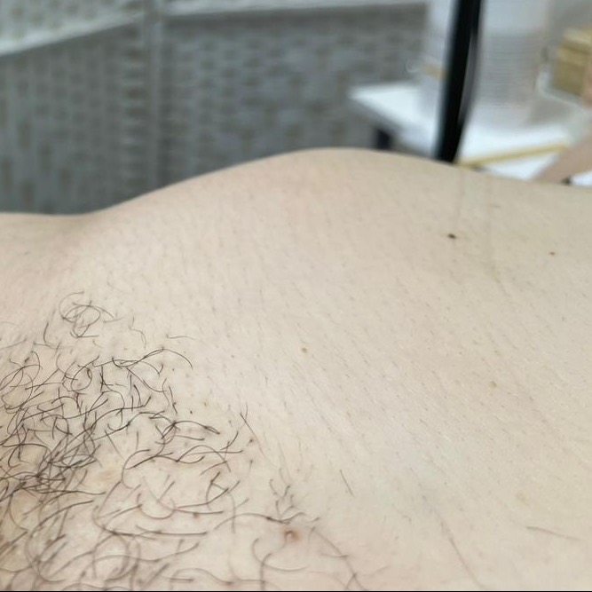 Изображение зоны бикини до процедуры шугаринга, показана кожа с растущими волосками